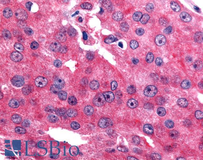 ESRRB / ERR Beta Antibody - Prostate, Carcinoma