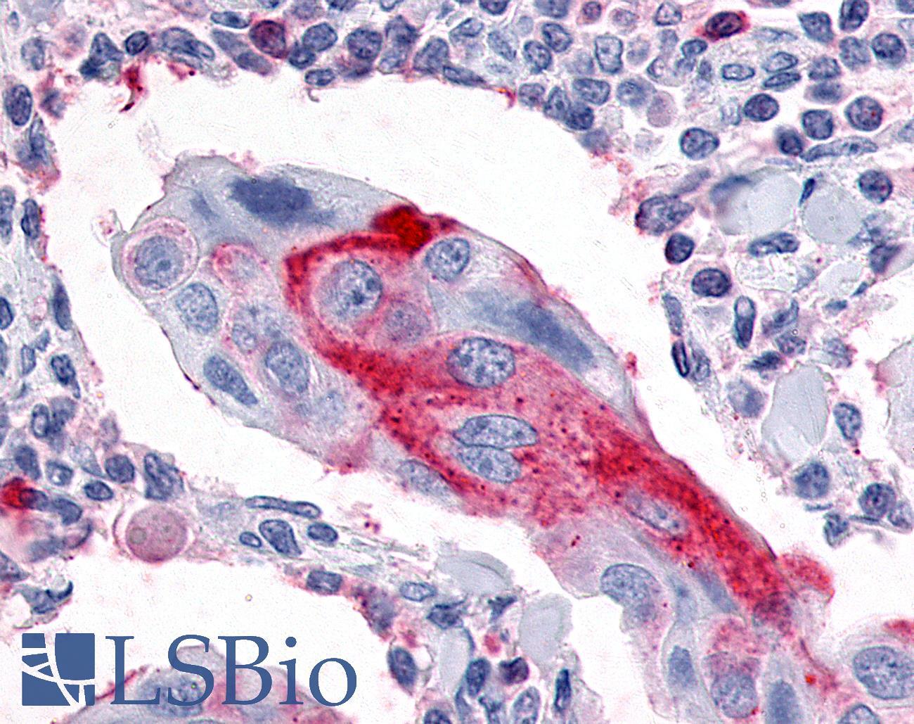 ESRRG / ERR Gamma Antibody - Breast, Carcinoma