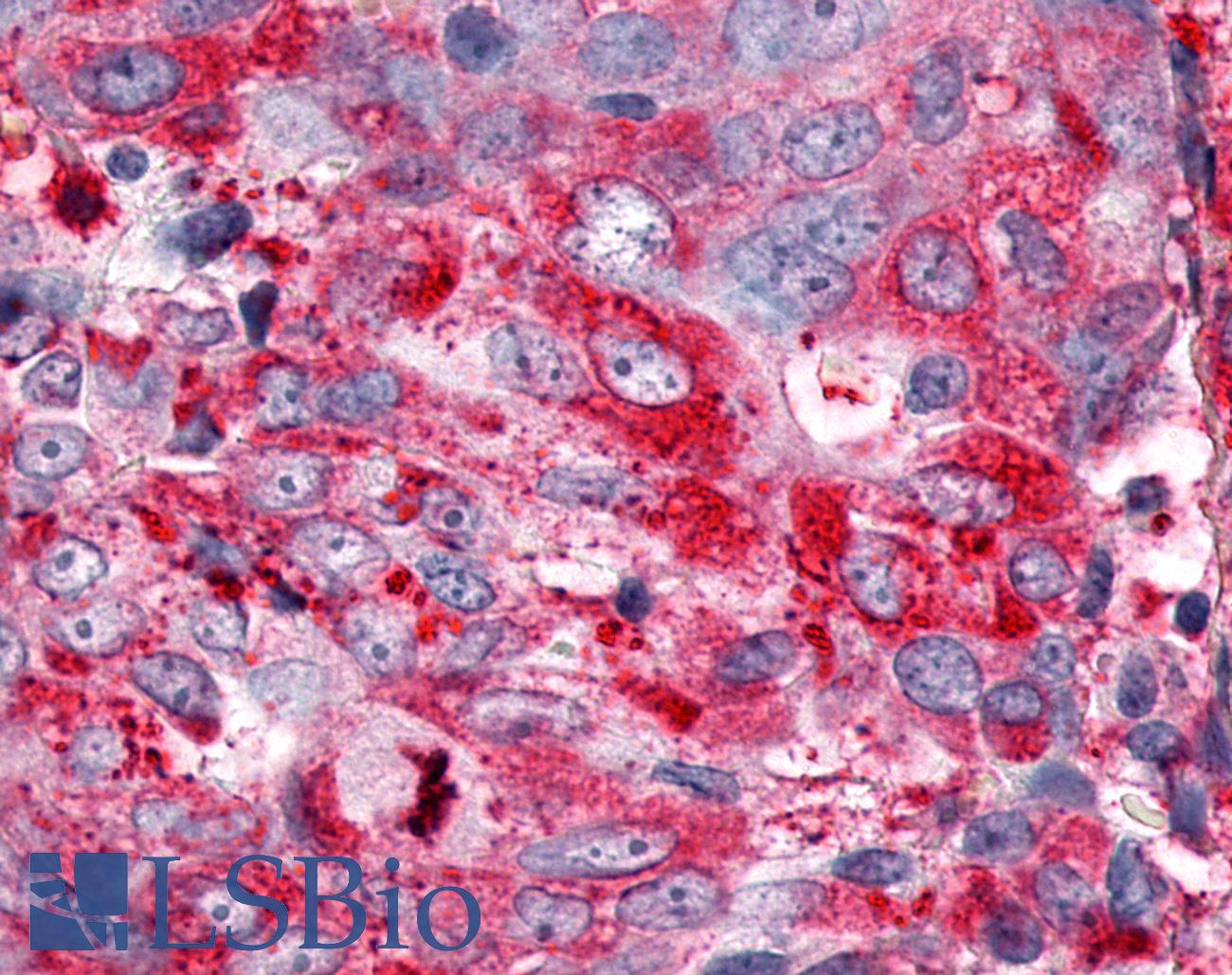 ESRRG / ERR Gamma Antibody - Ovary, carcinoma