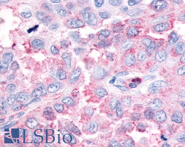 ESRRG / ERR Gamma Antibody - Lung, Non Small-Cell Carcinoma