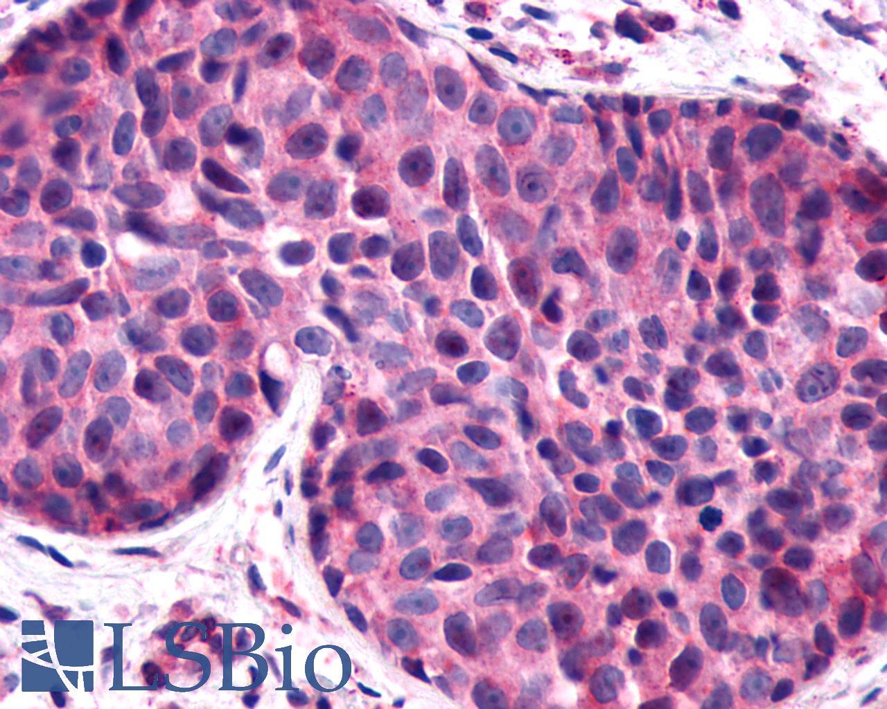 F2RL1 / PAR2 Antibody - Breast, Carcinoma