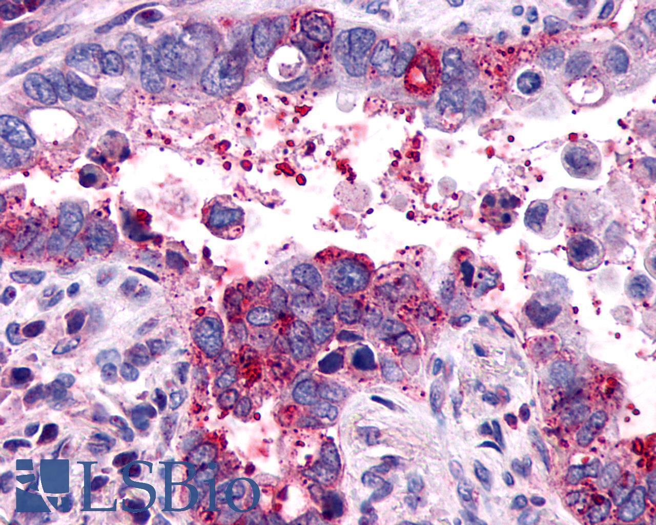 F2RL1 / PAR2 Antibody - Lung, adenocarcinoma