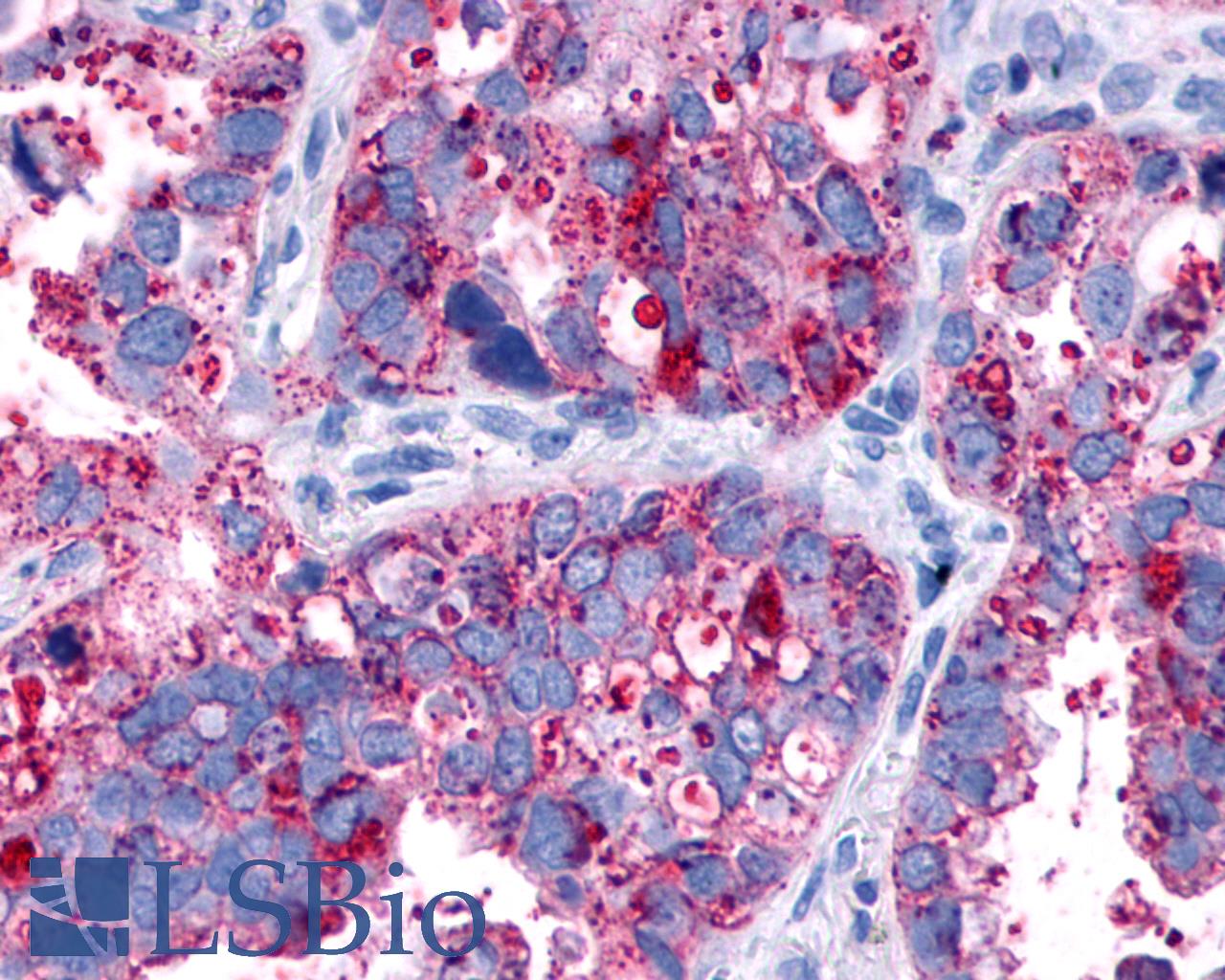 F2RL1 / PAR2 Antibody - Lung, Adenocarcinoma