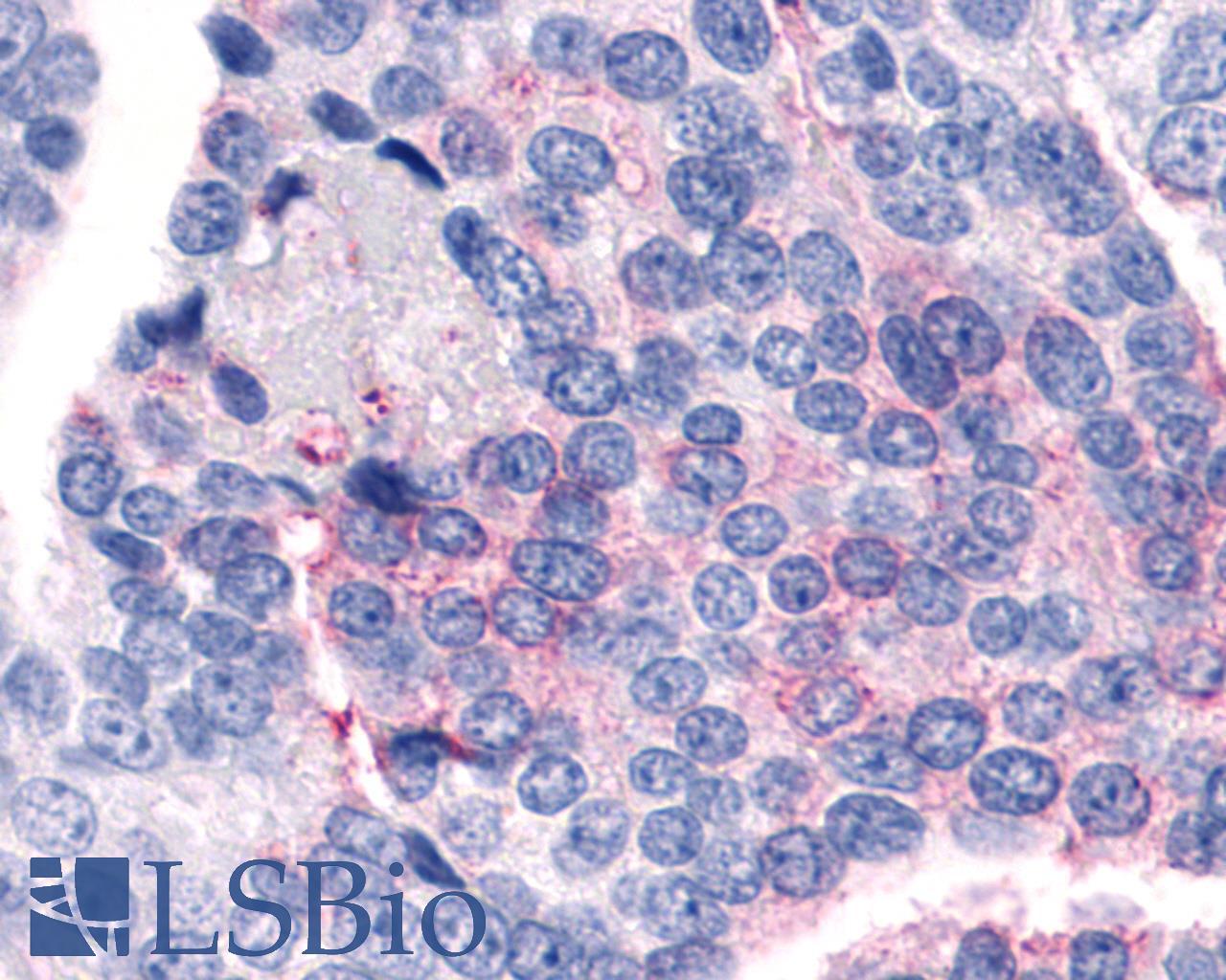 F2RL1 / PAR2 Antibody - Prostate, Carcinoma