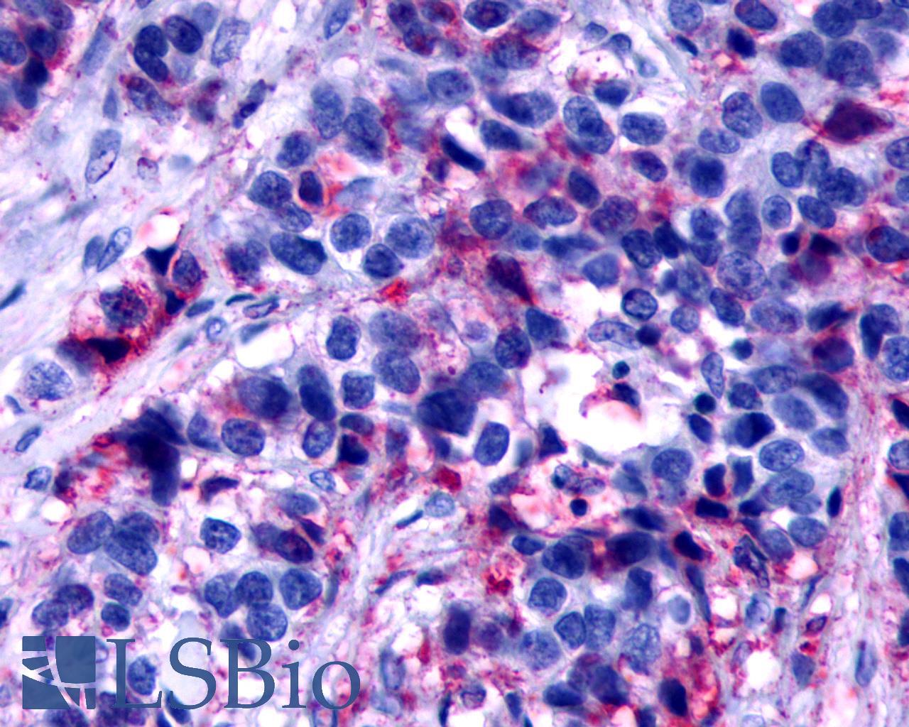 F2RL2 / PAR3 Antibody - Breast, Carcinoma
