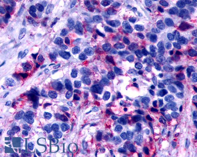 F2RL2 / PAR3 Antibody - Breast, Carcinoma