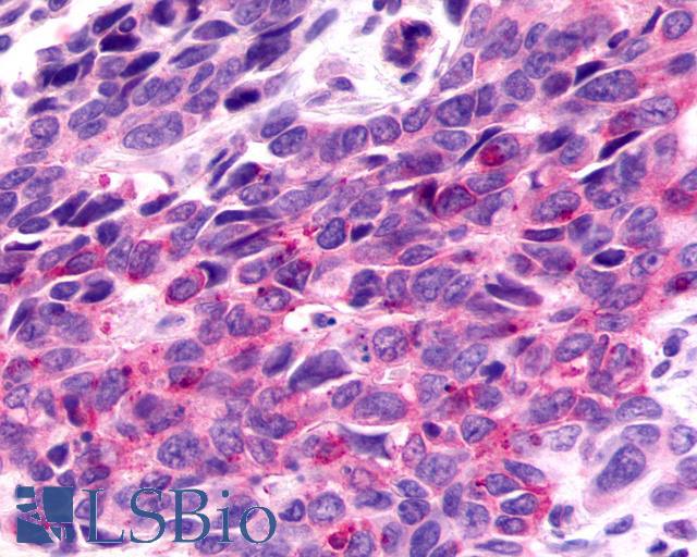 F2RL3 / PAR4 Antibody - Breast, Carcinoma