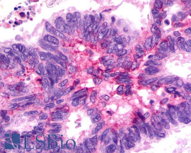 F2RL3 / PAR4 Antibody - Colon, Carcinoma