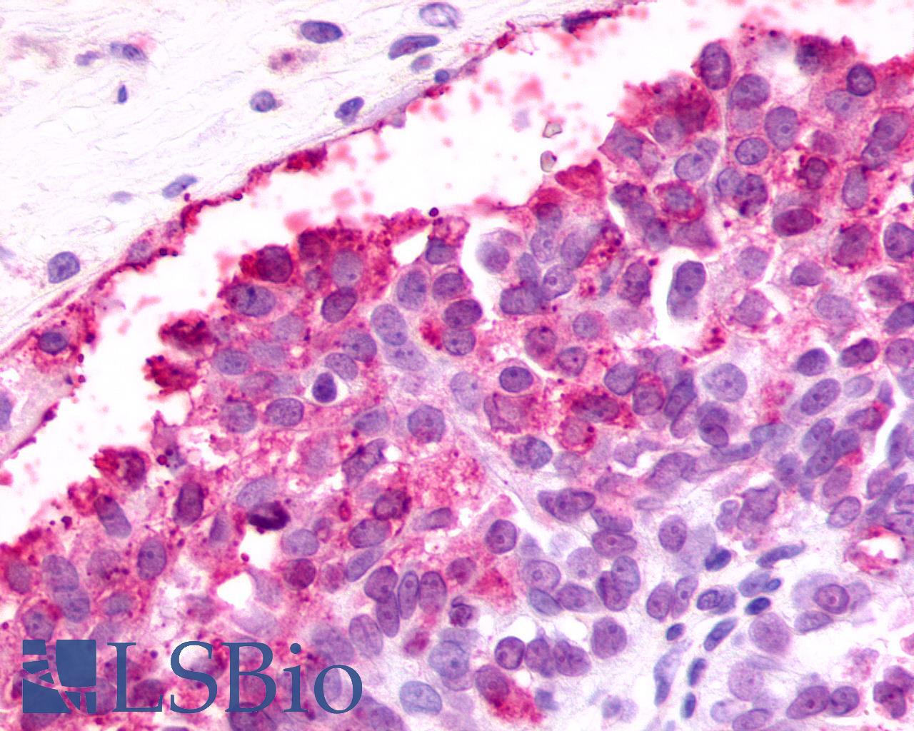F2RL3 / PAR4 Antibody - Ovary, carcinoma