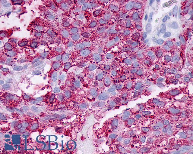F2RL3 / PAR4 Antibody - Ovary, Carcinoma