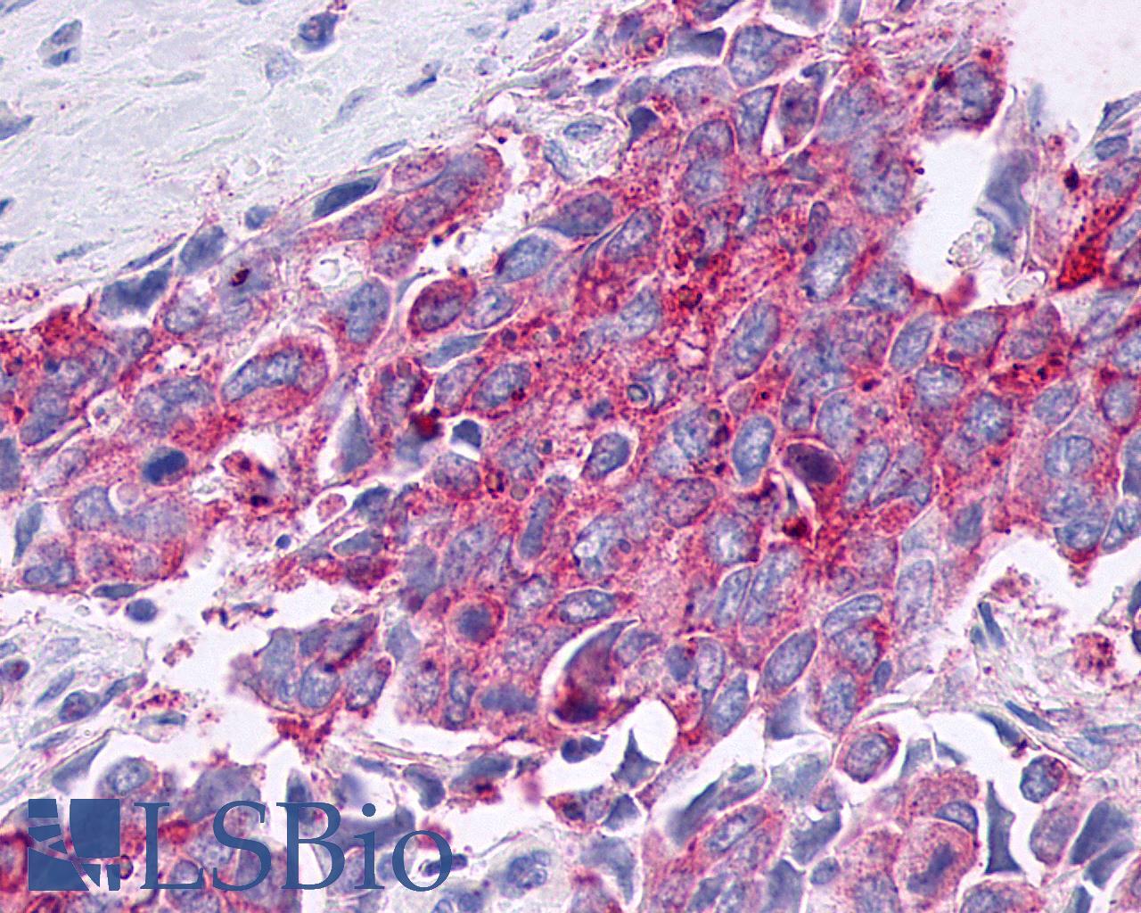 F2RL3 / PAR4 Antibody - Breast, Carcinoma