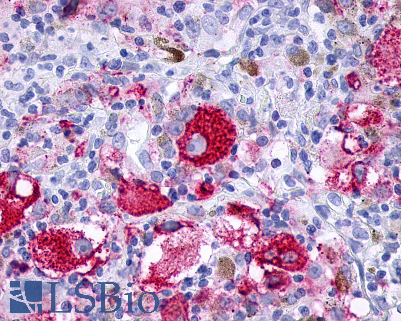 F2RL3 / PAR4 Antibody - Skin, Malignant Melanoma