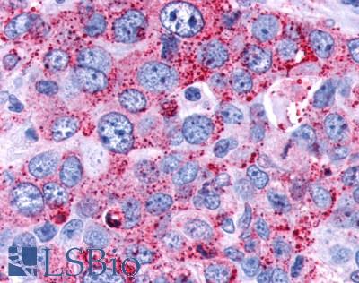 FAK / Focal Adhesion Kinase Antibody - Lung, non small cell carcinoma