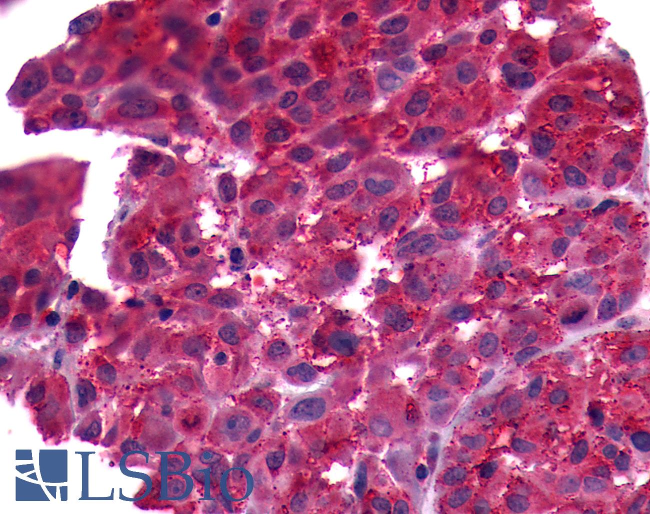 FP / PTGFR Antibody - Anti-FP / PTGFR antibody IHC of human Skin, Melanoma. Immunohistochemistry of formalin-fixed, paraffin-embedded tissue after heat-induced antigen retrieval.