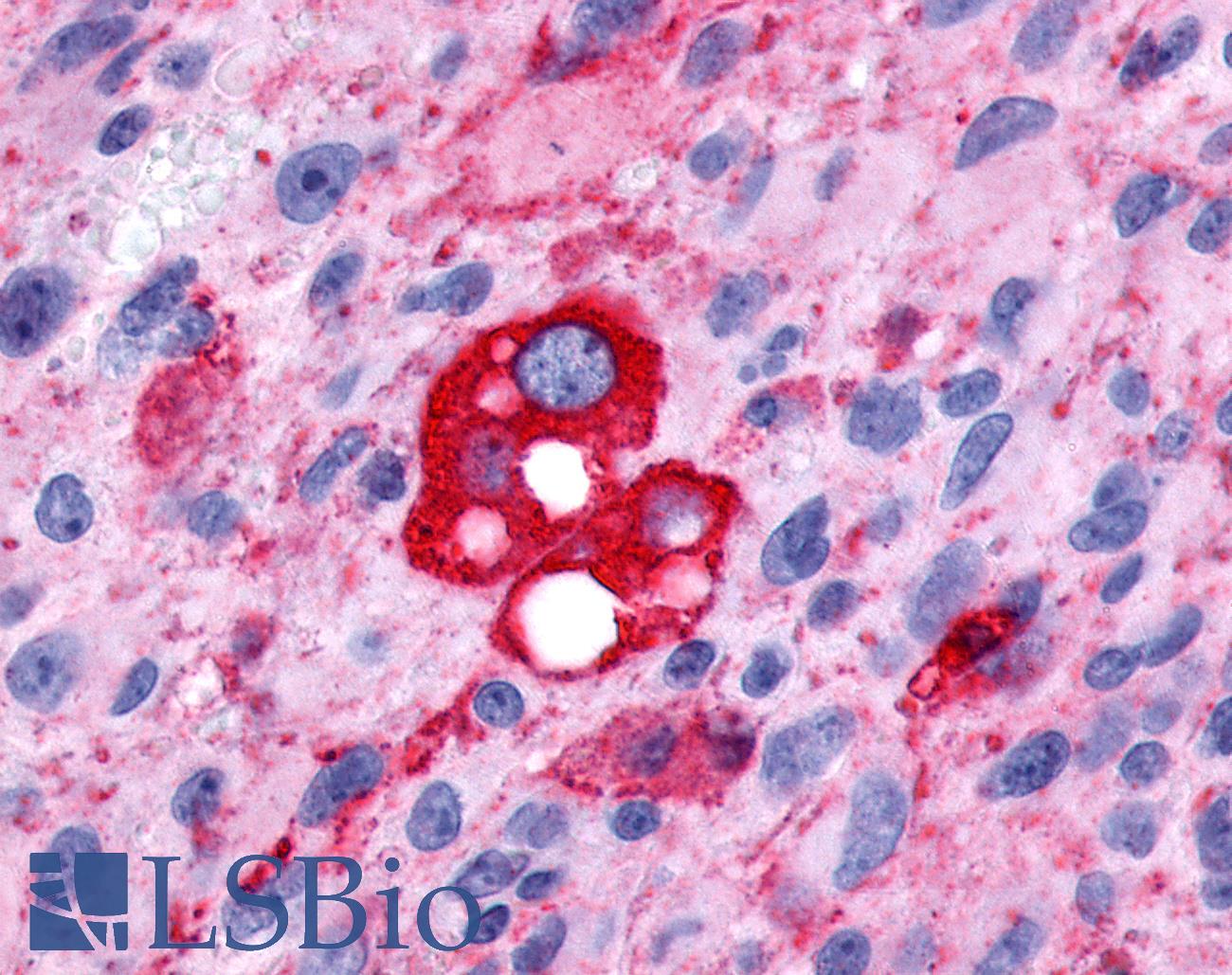 FP / PTGFR Antibody - Brain, Glioblastoma