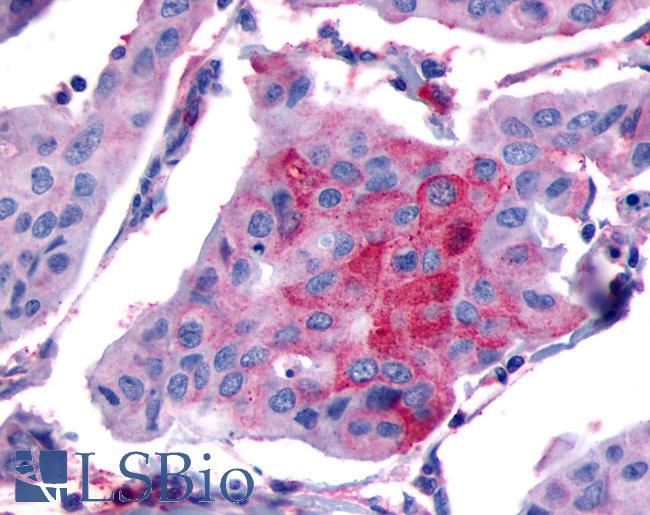 FP / PTGFR Antibody - Breast, Carcinoma