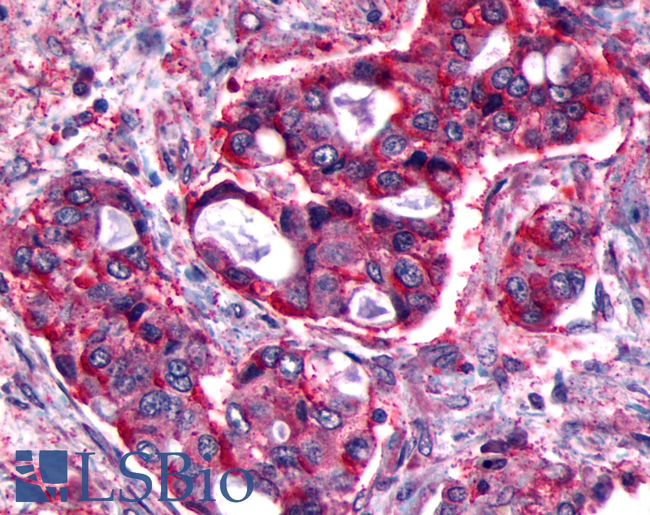 FP / PTGFR Antibody - Lung, Non Small-Cell Carcinoma