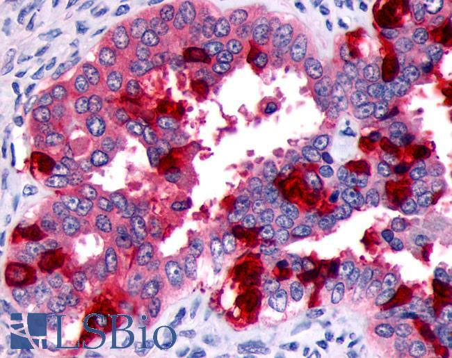 FP / PTGFR Antibody - Ovary, carcinoma