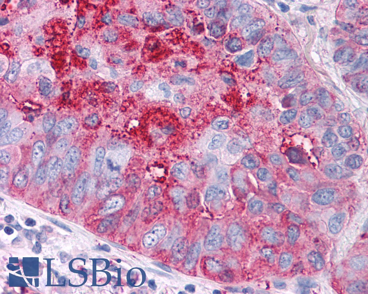 FZD1 / Frizzled 1 Antibody - Lung, non small-cell carcinoma