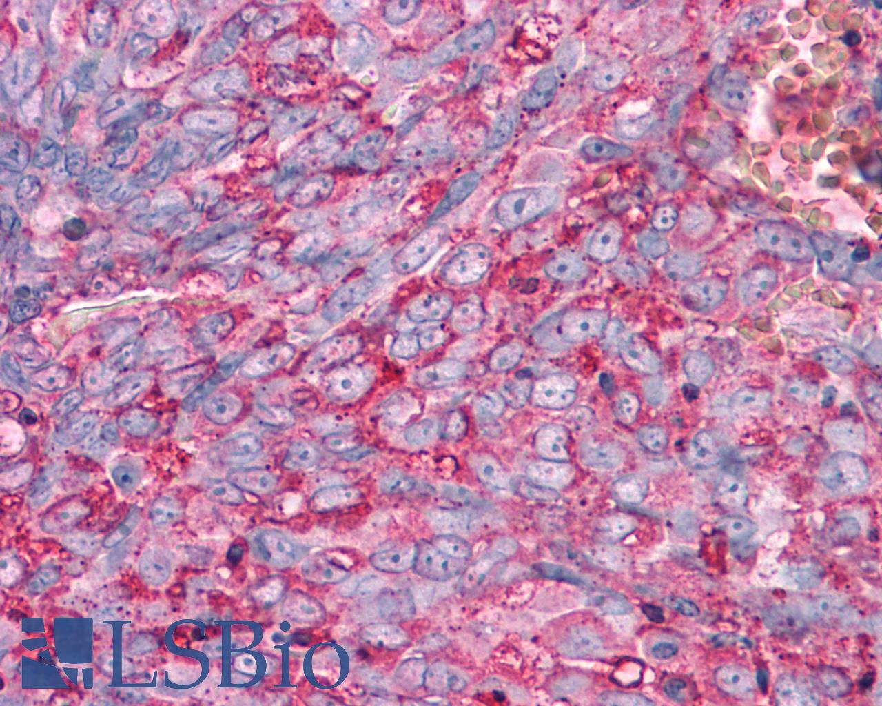 FZD1 / Frizzled 1 Antibody - Ovary, Carcinoma