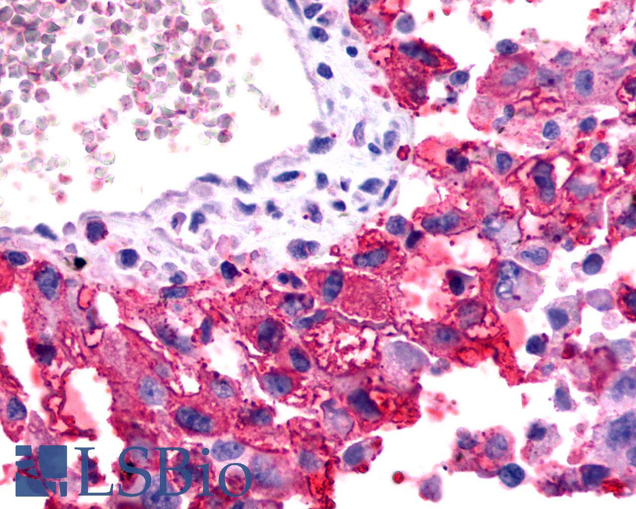 FZD2 / Frizzled 2 Antibody - Lung, Non Small-Cell Carcinoma