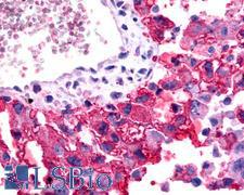 FZD2 / Frizzled 2 Antibody - Lung, Non Small-Cell Carcinoma