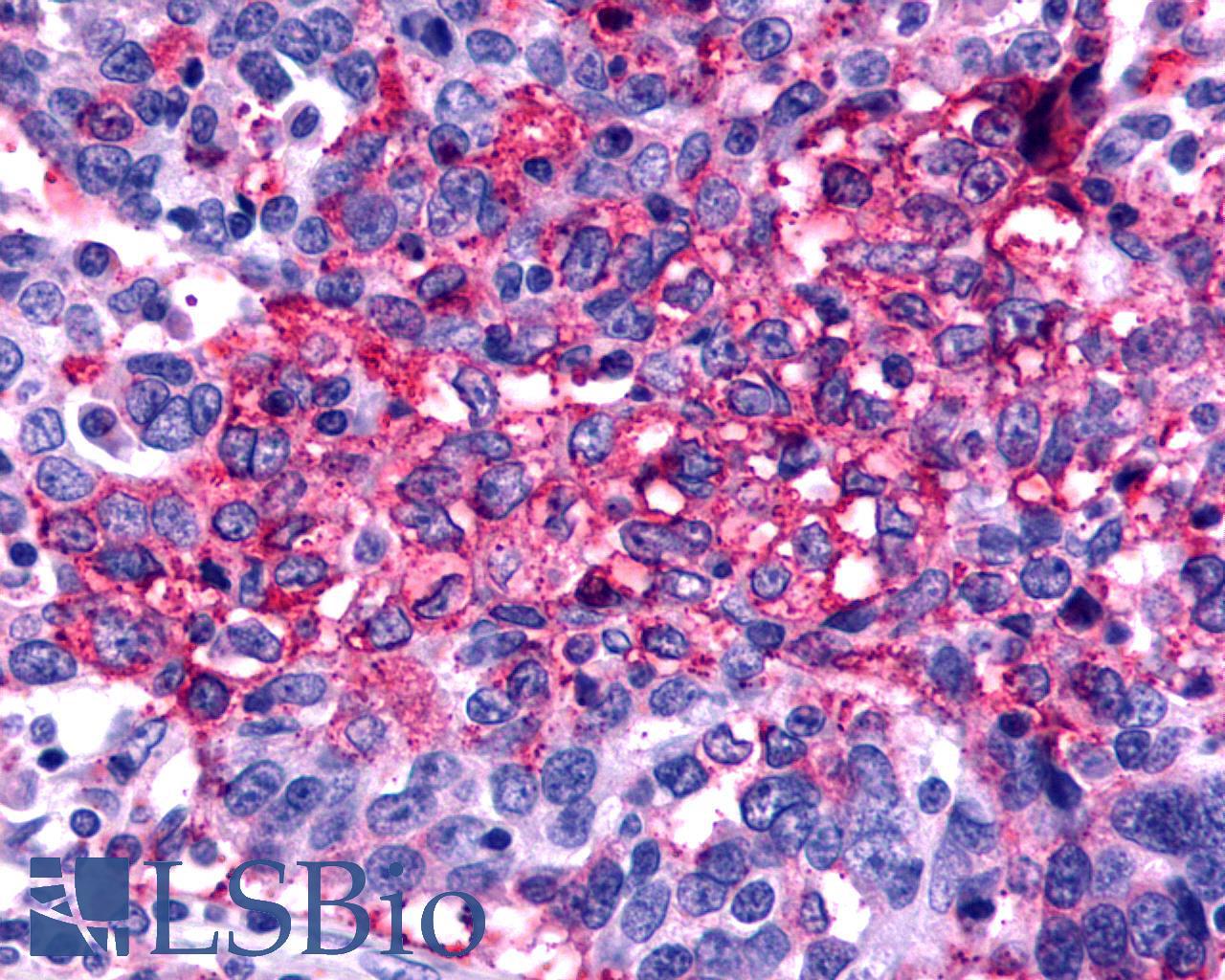 FZD2 / Frizzled 2 Antibody - Ovary, Carcinoma