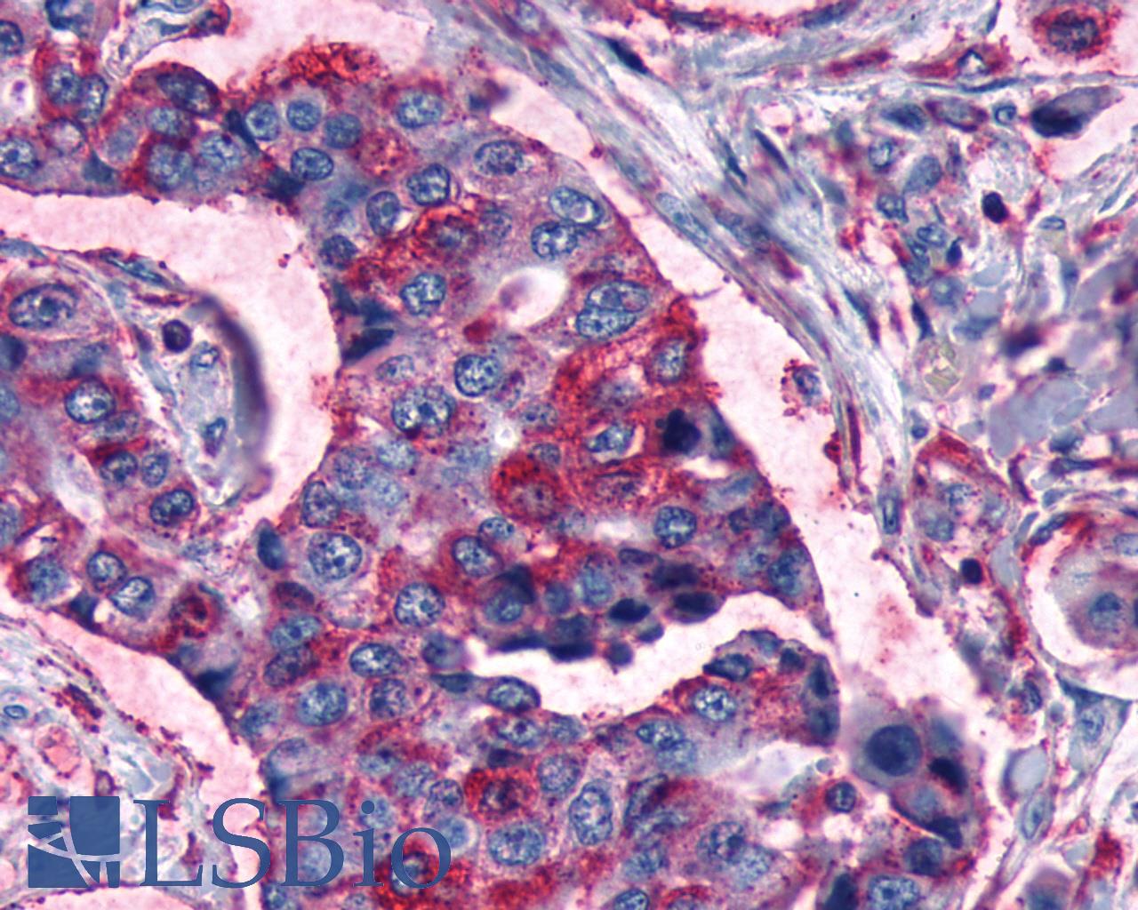FZD3 / Frizzled 3 Antibody - Lung, Non Small-Cell Carcinoma