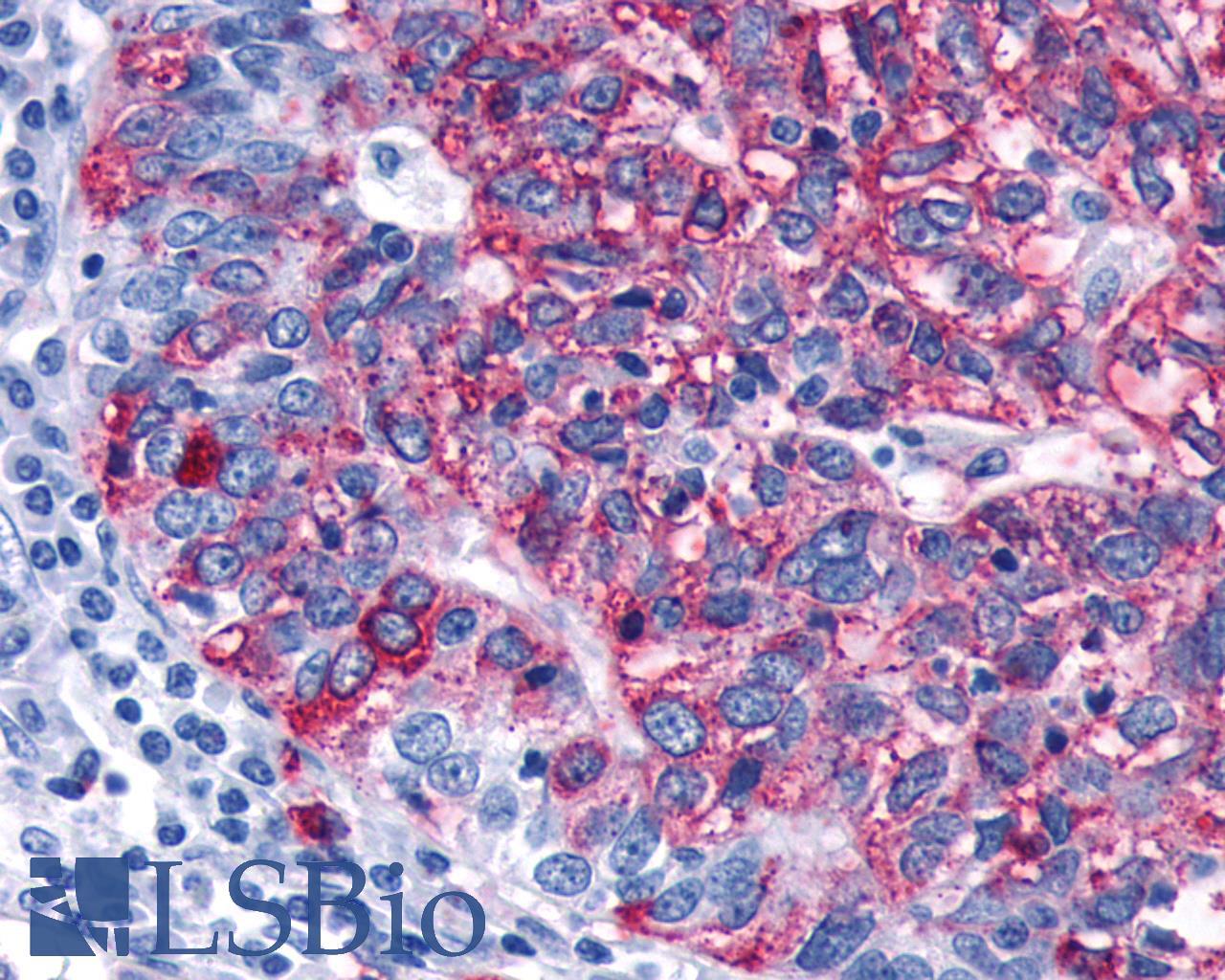 FZD3 / Frizzled 3 Antibody - Ovary, carcinoma