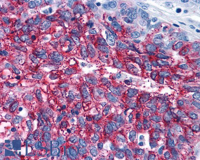 FZD3 / Frizzled 3 Antibody - Ovary, carcinoma