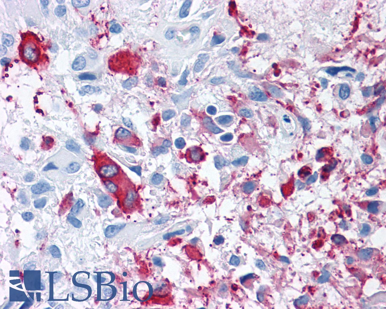 FZD3 / Frizzled 3 Antibody - Anti-FZD3 / Frizzled 3 antibody IHC of human Brain, Glioblastoma. Immunohistochemistry of formalin-fixed, paraffin-embedded tissue after heat-induced antigen retrieval.