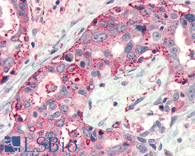 FZD4 / Frizzled 4 Antibody - Anti-FZD4 / Frizzled 4 antibody IHC of human Pancreas, Carcinoma. Immunohistochemistry of formalin-fixed, paraffin-embedded tissue after heat-induced antigen retrieval.