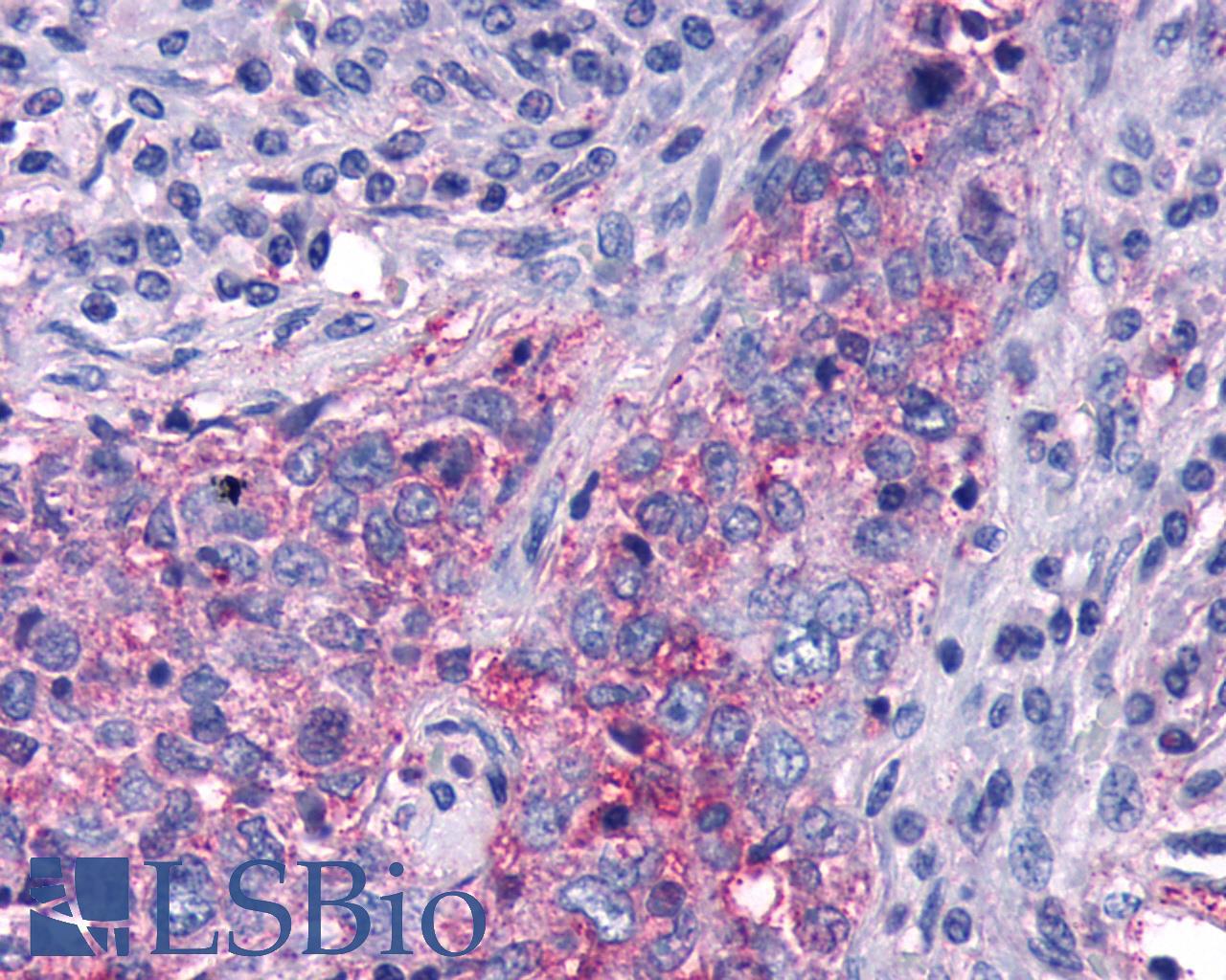 FZD5 / Frizzled 5 Antibody - Breast, Carcinoma