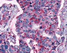 FZD5 / Frizzled 5 Antibody - Anti-FZD5 / Frizzled 5 antibody IHC of human Lung, Non-Small Cell Carcinoma. Immunohistochemistry of formalin-fixed, paraffin-embedded tissue after heat-induced antigen retrieval.