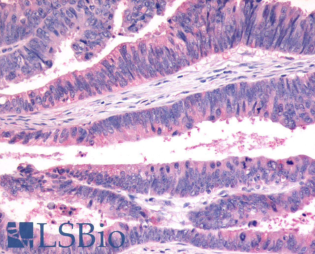 FZD7 / Frizzled 7 Antibody - Anti-FZD7 / Frizzled 7 antibody IHC of human Colon, Carcinoma. Immunohistochemistry of formalin-fixed, paraffin-embedded tissue after heat-induced antigen retrieval.