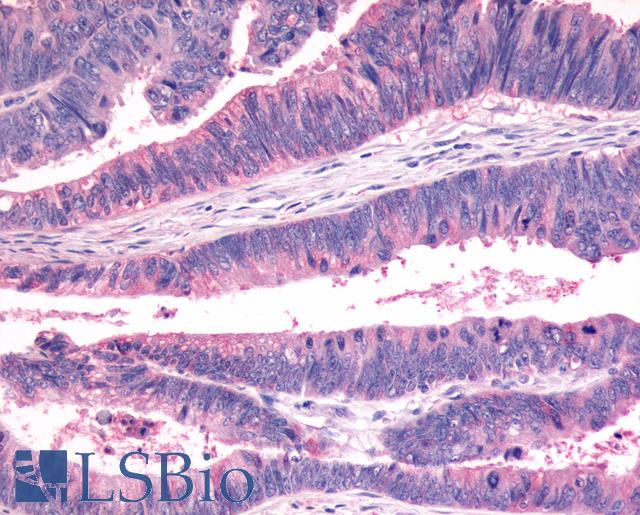 FZD7 / Frizzled 7 Antibody - Anti-FZD7 / Frizzled 7 antibody IHC of human Colon, Carcinoma. Immunohistochemistry of formalin-fixed, paraffin-embedded tissue after heat-induced antigen retrieval.