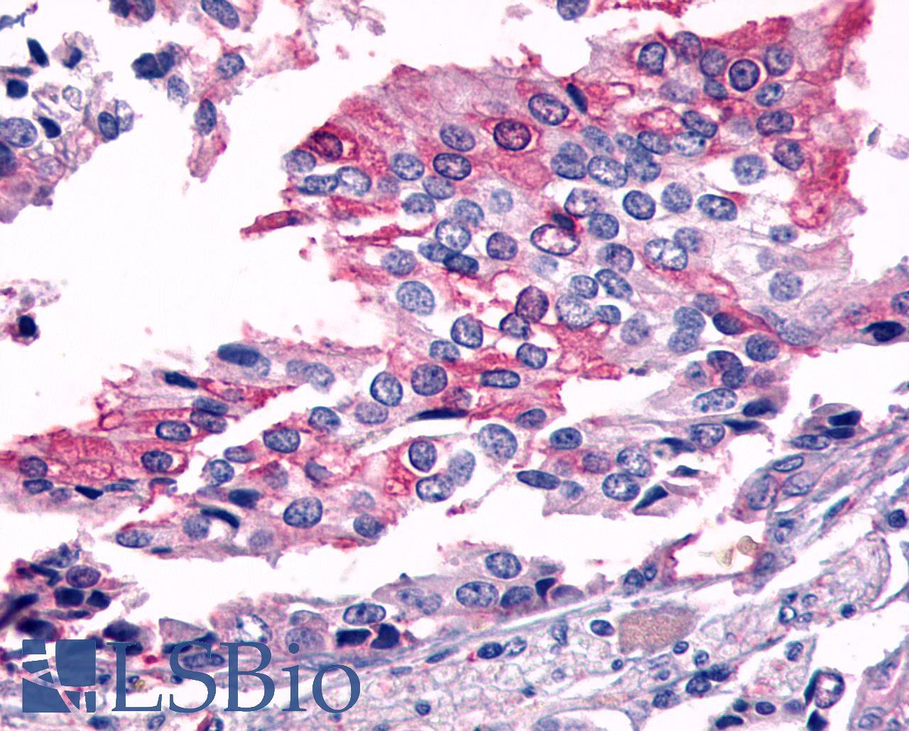FZD7 / Frizzled 7 Antibody - Prostate carcinoma