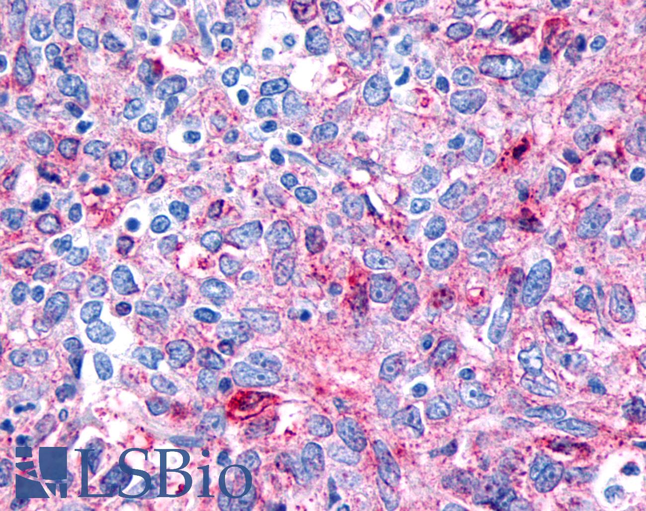 FZD8 / Frizzled 8 Antibody - Anti-FZD8 / Frizzled 8 antibody IHC of human Ovary, Carcinoma. Immunohistochemistry of formalin-fixed, paraffin-embedded tissue after heat-induced antigen retrieval.