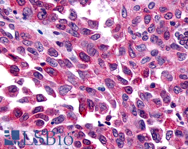 FZD8 / Frizzled 8 Antibody - Lung, Non Small-Cell Carcinoma