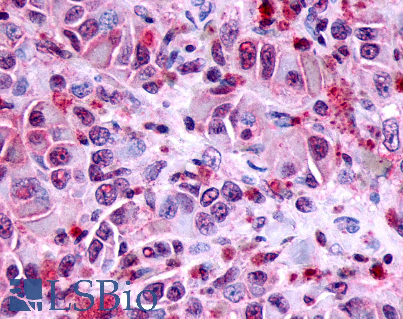 FZD8 / Frizzled 8 Antibody - Skin, Malignant Melanoma