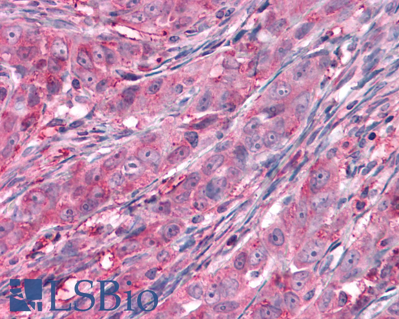FZD9 / Frizzled 9 Antibody - Ovary, carcinoma