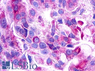 GALR3 / Galanin Receptor 3 Antibody - Lung, adenocarcinoma
