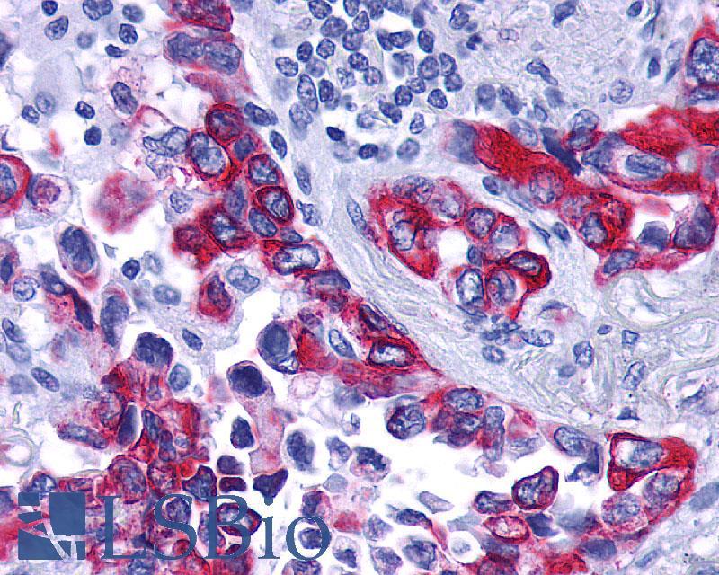 GPBAR1 / TGR5 Antibody - Lung, Non Small-Cell Carcinoma