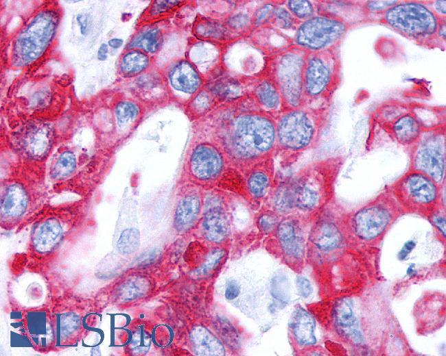GPBAR1 / TGR5 Antibody - Pancreas, carcinoma