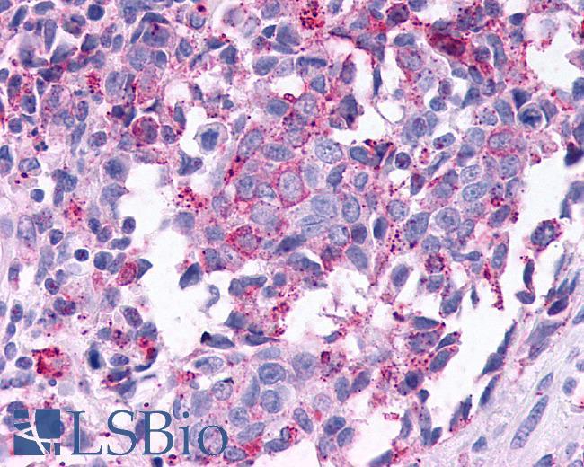 GPBAR1 / TGR5 Antibody - Breast, Carcinoma
