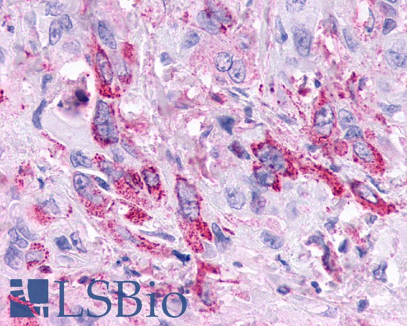 GPBAR1 / TGR5 Antibody - Pancreas, carcinoma
