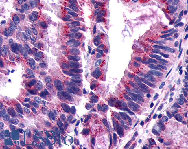 GPCR6 / GPR101 Antibody - Colon, Carcinoma