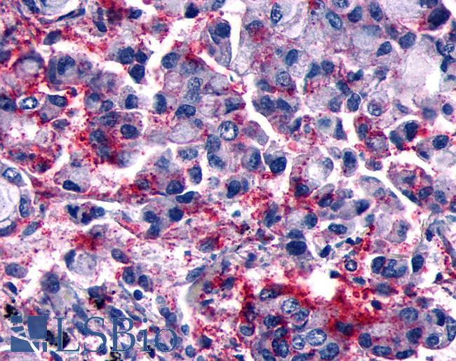 GPCR6 / GPR101 Antibody - Lung, Non Small-Cell Carcinoma