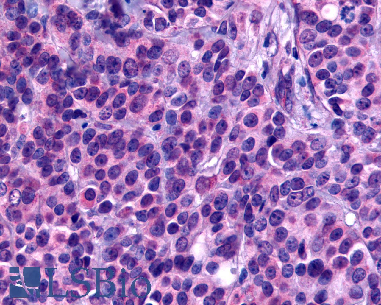 GPCR6 / GPR101 Antibody - Breast, carcinoma