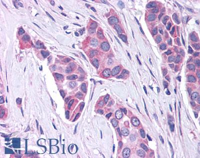 GPER1 / GPR30 Antibody - Anti-GPR30 antibody IHC of human breast carcinoma. Immunohistochemistry of formalin-fixed, paraffin-embedded tissue after heat-induced antigen retrieval.
